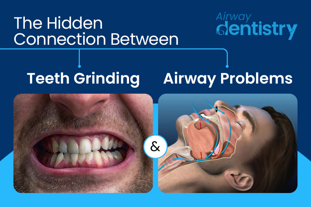 Teeth Grinding and Airway Problems